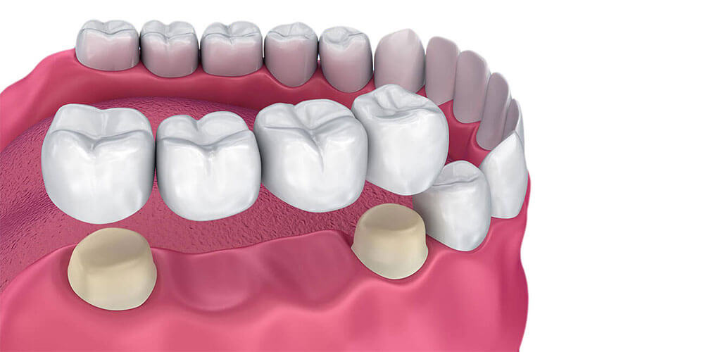Dental Bridges Thornhill