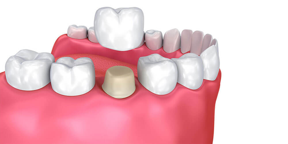 Dental Crowns Thornhill