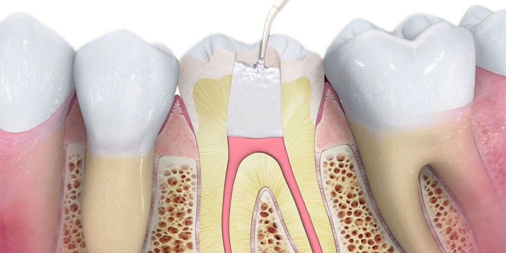 Root Canal Treatment Thornhill
