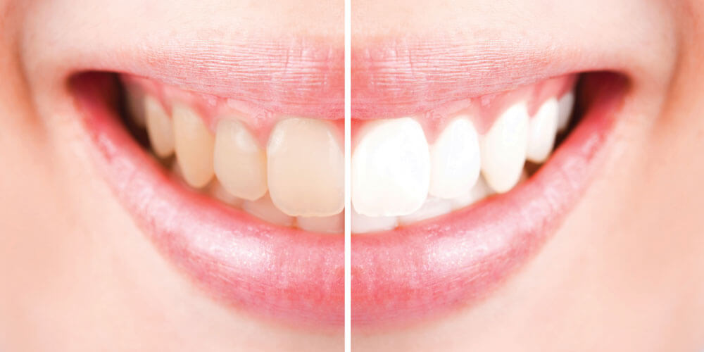 Teeth Whitening Thornhill